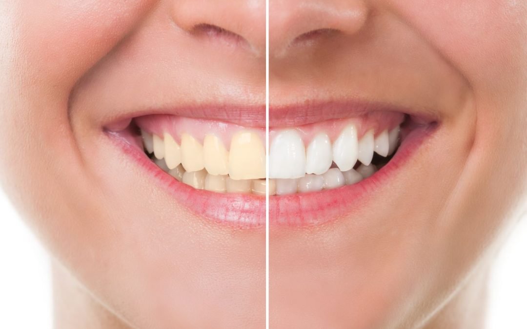 Tandblegning giver dig det naturlige smil tilbage